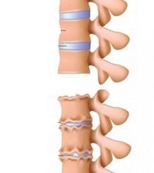 Στάδια ράμπων οστεοχονδρισμού του λαιμού