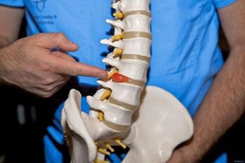 Γιατί η πλάτη βλάπτει στην κάτω πλάτη και τι να κάνει