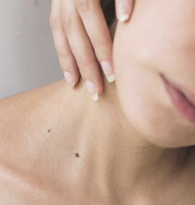 Η δυσκαμψία στον αυχένα είναι ένα από τα συμπτώματα του αρχικού σταδίου της οστεοχόνδρωσης της αυχενικής μοίρας της σπονδυλικής στήλης